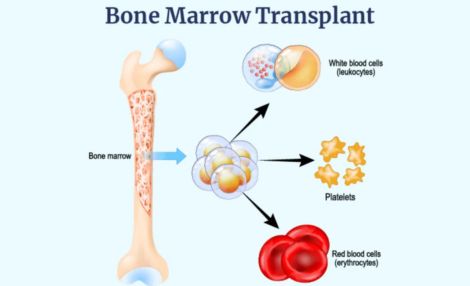 Bone Marrow Transplantation by Pediatric Hematologist in India, Dr. Shweta Bansal